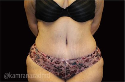 Tummy Tuck Before & After Patient #2850
