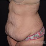 Tummy Tuck Before & After Patient #2850