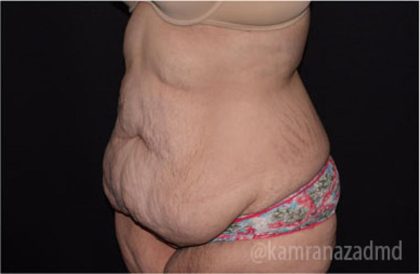 Tummy Tuck Before & After Patient #2850