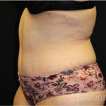 Tummy Tuck Before & After Patient #2850