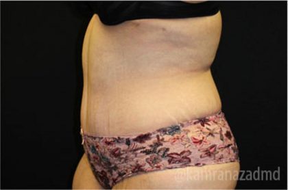 Tummy Tuck Before & After Patient #2850
