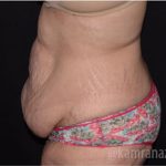 Tummy Tuck Before & After Patient #2850