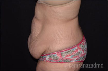 Tummy Tuck Before & After Patient #2850