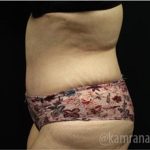 Tummy Tuck Before & After Patient #2850