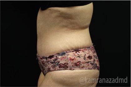 Tummy Tuck Before & After Patient #2850