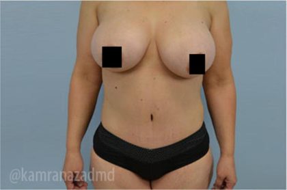 Tummy Tuck Before & After Patient #2851