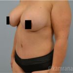 Tummy Tuck Before & After Patient #2851