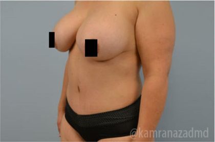 Tummy Tuck Before & After Patient #2851