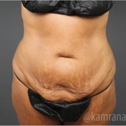 Tummy Tuck Before & After Patient #2852
