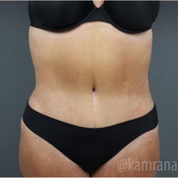 Tummy Tuck Before & After Patient #2852