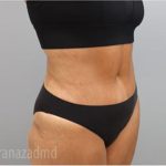 Tummy Tuck Before & After Patient #2852