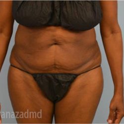 Tummy Tuck Before & After Patient #2825