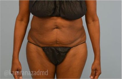 Tummy Tuck Before & After Patient #2825