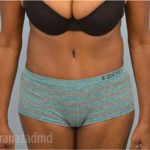 Tummy Tuck Before & After Patient #2825