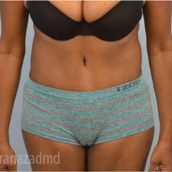 Tummy Tuck Before & After Patient #2825