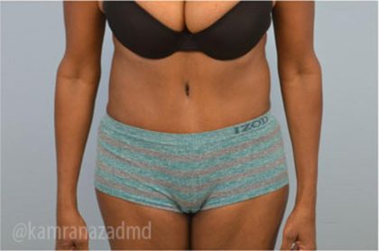 Tummy Tuck Before & After Patient #2825