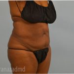 Tummy Tuck Before & After Patient #2825
