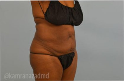 Tummy Tuck Before & After Patient #2825