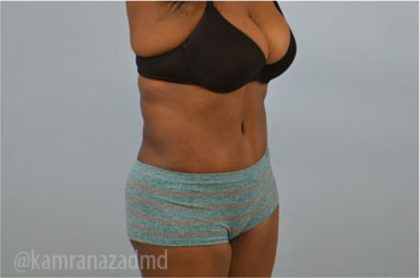 Tummy Tuck Before & After Patient #2825