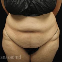 Tummy Tuck Before & After Patient #2853
