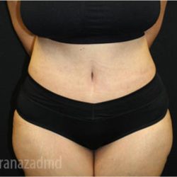 Tummy Tuck Before & After Patient #2853