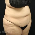 Tummy Tuck Before & After Patient #2853
