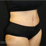 Tummy Tuck Before & After Patient #2853