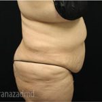Tummy Tuck Before & After Patient #2853