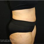 Tummy Tuck Before & After Patient #2853