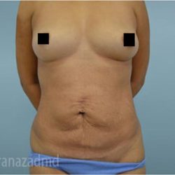Tummy Tuck Before & After Patient #2854