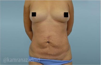 Tummy Tuck Before & After Patient #2854