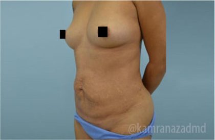 Tummy Tuck Before & After Patient #2854