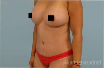 Tummy Tuck Before & After Patient #2854