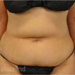 Tummy Tuck Before & After Patient #2855