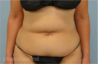 Tummy Tuck Before & After Patient #2855