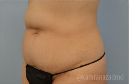 Tummy Tuck Before & After Patient #2855