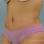 Tummy Tuck Before & After Patient #2855