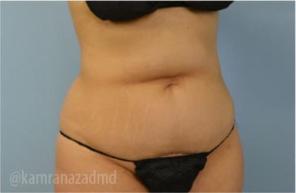 Tummy Tuck Before & After Patient #2855