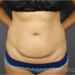 Tummy Tuck Before & After Patient #2856