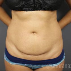 Tummy Tuck Before & After Patient #2856