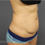 Tummy Tuck Before & After Patient #2856
