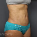 Tummy Tuck Before & After Patient #2856
