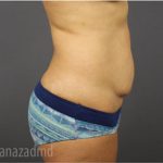Tummy Tuck Before & After Patient #2856