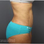 Tummy Tuck Before & After Patient #2856