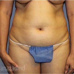 Tummy Tuck Before & After Patient #2857