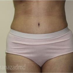 Tummy Tuck Before & After Patient #2857