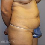 Tummy Tuck Before & After Patient #2857