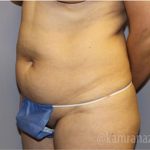 Tummy Tuck Before & After Patient #2857