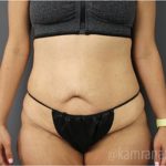 Tummy Tuck Before & After Patient #2858