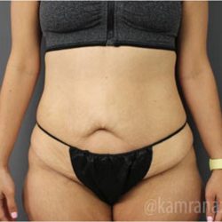 Tummy Tuck Before & After Patient #2858